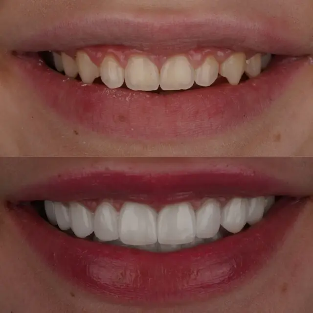 Invisalign result at Cherry Creek Restorative Dentistry in Denver, CO