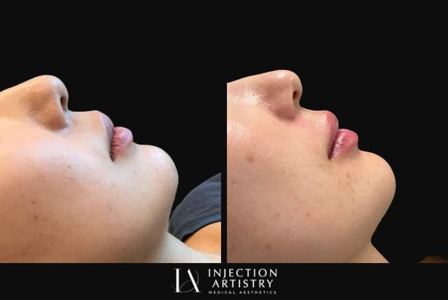 Lip Filler result at Injection Artistry in Newport Beach, CA