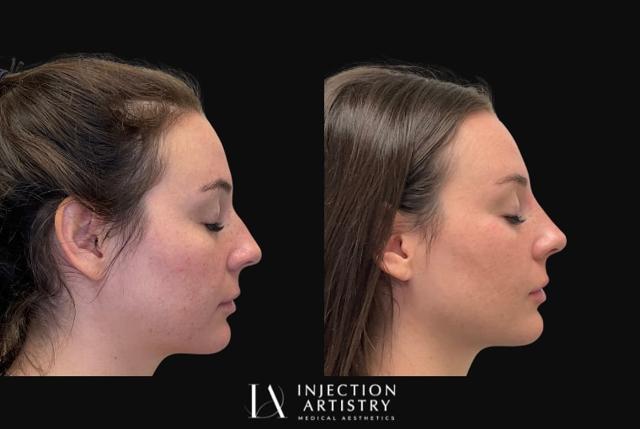 Functional Rhinoplasty result at Injection Artistry in Newport Beach, CA