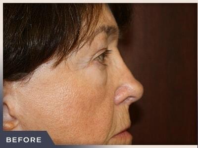 Blepharoplasty before at Aura Boulder in Boulder, CO