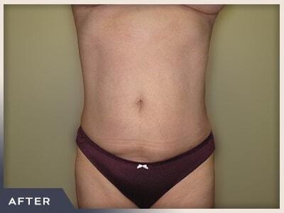 Liposuction after at Aura Boulder in Boulder, CO