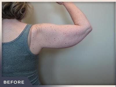 Liposuction before at Aura Boulder in Boulder, CO