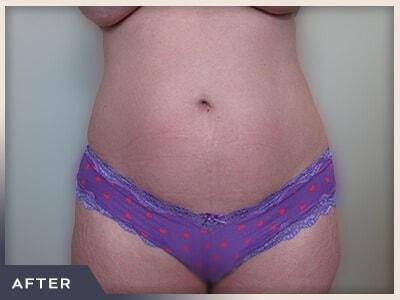 Liposuction after at Aura Boulder in Boulder, CO