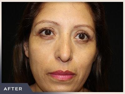 Blepharoplasty after at Aura Boulder in Boulder, CO
