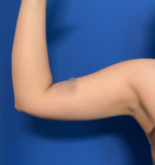 Liposuction after at Aura Boulder in Boulder, CO