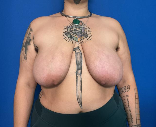 Breast Reduction before at Aura Boulder in Boulder, CO