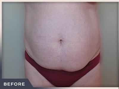 Liposuction before at Aura Boulder in Boulder, CO