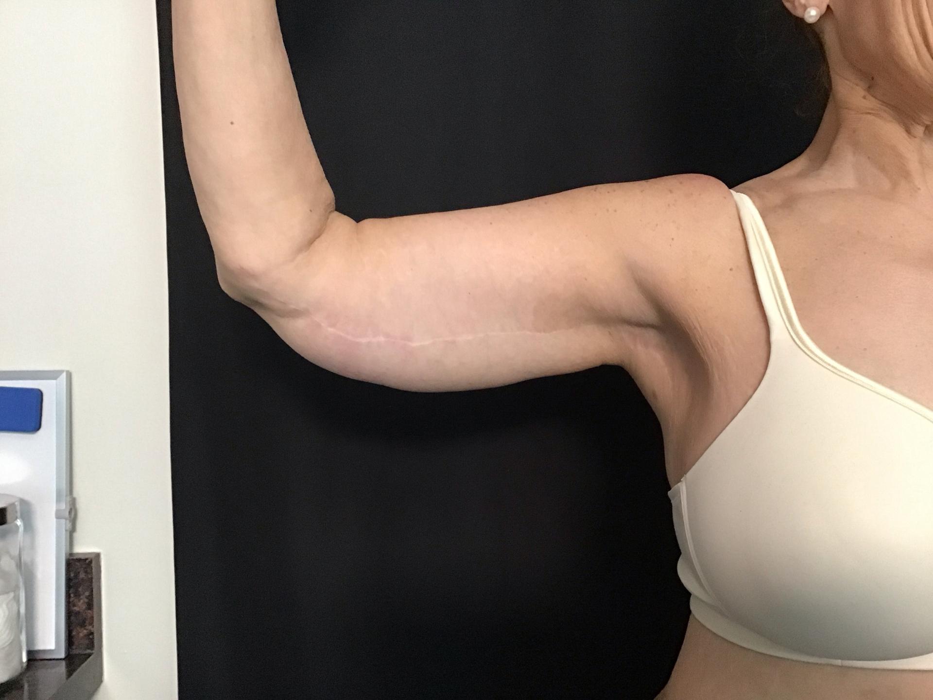 Aura Boulder arm lift after — Boulder, CO