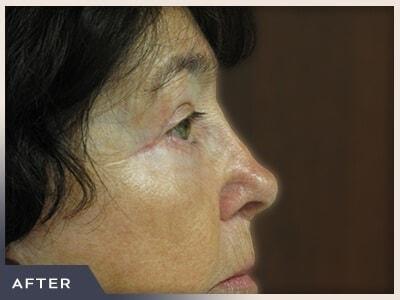 Blepharoplasty after at Aura Boulder in Boulder, CO