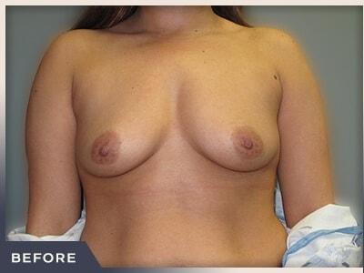 Breast Augmentation before at Aura Boulder in Boulder, CO