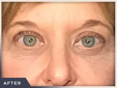 Blepharoplasty after at Aura Boulder in Boulder, CO