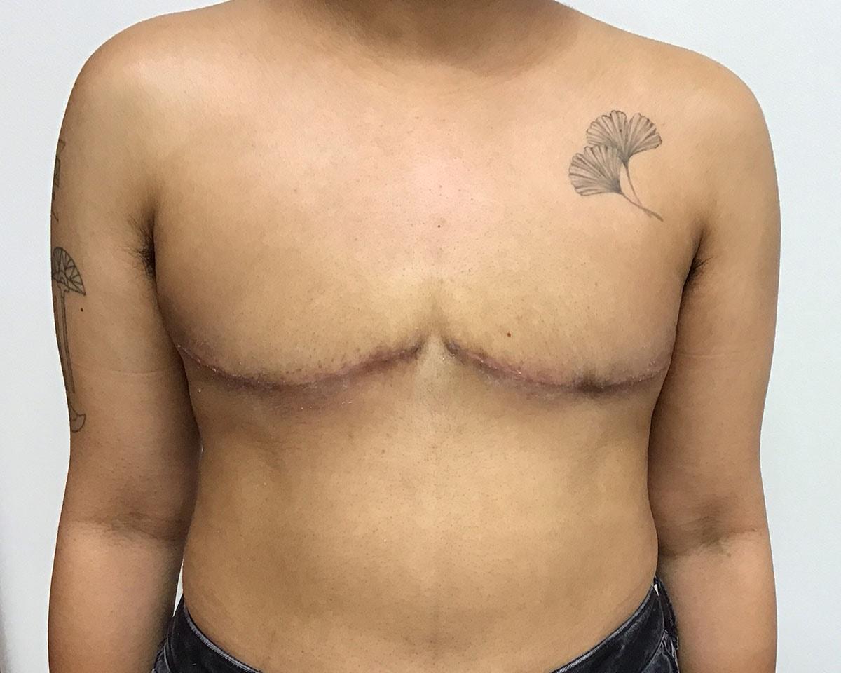 Aura Boulder gender affirming top surgery after — Boulder, CO