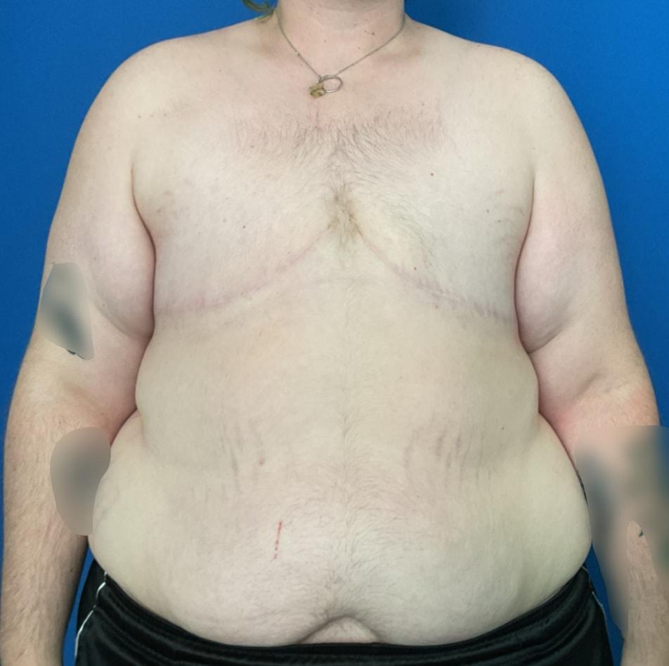Aura Boulder gender affirming top surgery after — Boulder, CO
