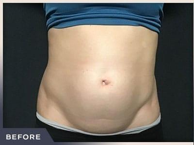 Liposuction before at Aura Boulder in Boulder, CO