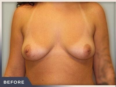 Breast Augmentation before at Aura Boulder in Boulder, CO