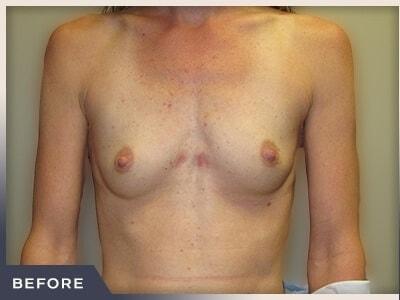 Breast Augmentation before at Aura Boulder in Boulder, CO