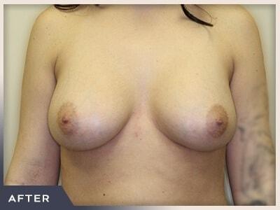 Breast Augmentation after at Aura Boulder in Boulder, CO