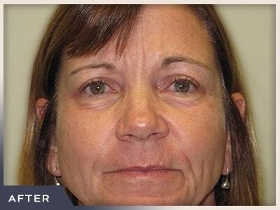 Blepharoplasty after at Aura Boulder in Boulder, CO