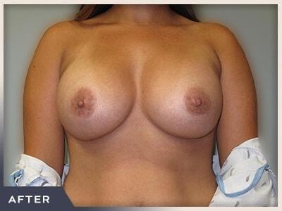 Breast Augmentation after at Aura Boulder in Boulder, CO