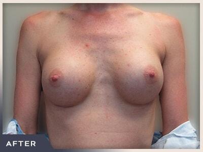 Breast Augmentation after at Aura Boulder in Boulder, CO