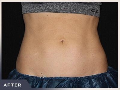 Aura Boulder fat freezing after — Boulder, CO