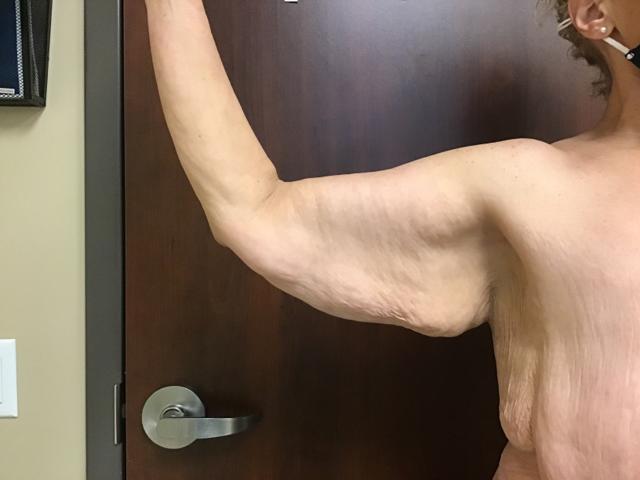 Arm Lift before at Aura Boulder in Boulder, CO
