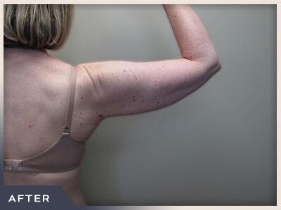 Liposuction after at Aura Boulder in Boulder, CO