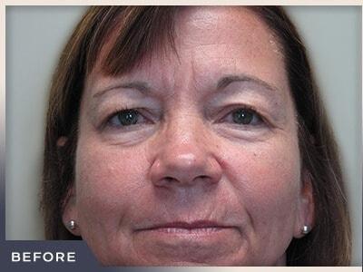 Blepharoplasty before at Aura Boulder in Boulder, CO