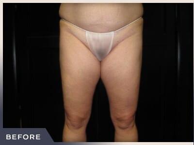 Liposuction before at Aura Boulder in Boulder, CO