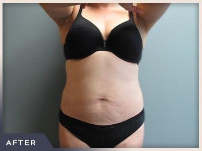 Liposuction after at Aura Boulder in Boulder, CO
