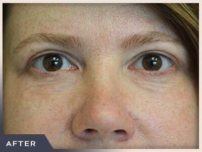 Blepharoplasty after at Aura Boulder in Boulder, CO