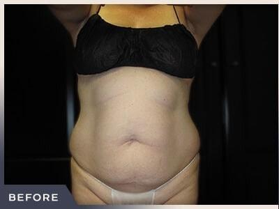 Liposuction before at Aura Boulder in Boulder, CO