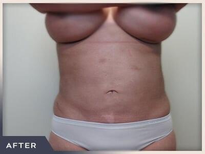 Liposuction after at Aura Boulder in Boulder, CO