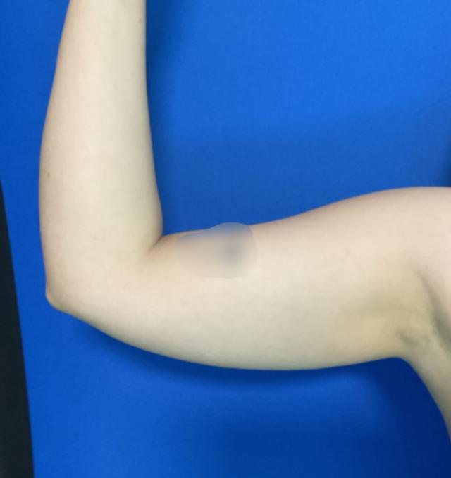 Liposuction before at Aura Boulder in Boulder, CO