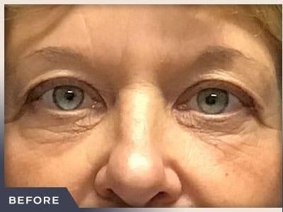 Blepharoplasty before at Aura Boulder in Boulder, CO