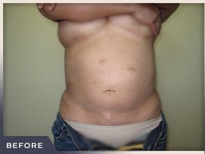 Liposuction before at Aura Boulder in Boulder, CO