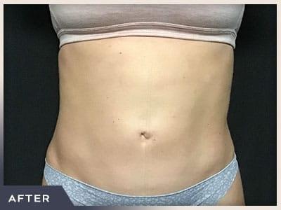Liposuction after at Aura Boulder in Boulder, CO