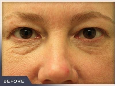 Blepharoplasty before at Aura Boulder in Boulder, CO