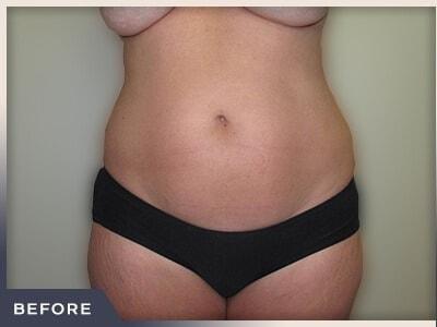 Liposuction before at Aura Boulder in Boulder, CO