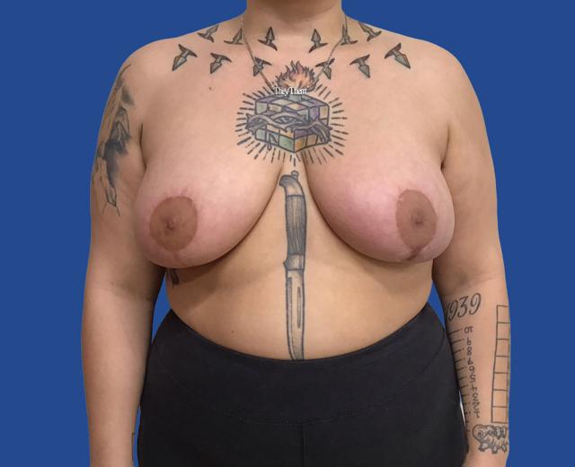 Breast Reduction after at Aura Boulder in Boulder, CO