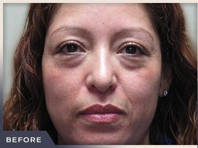 Blepharoplasty before at Aura Boulder in Boulder, CO