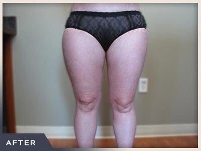 Liposuction after at Aura Boulder in Boulder, CO