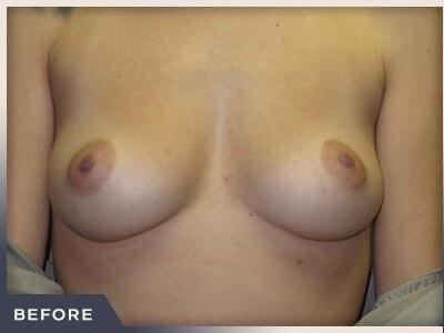 Breast Augmentation before at Aura Boulder in Boulder, CO