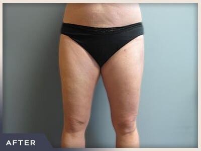 Liposuction after at Aura Boulder in Boulder, CO