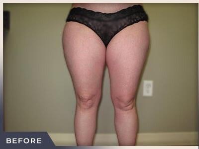 Liposuction before at Aura Boulder in Boulder, CO
