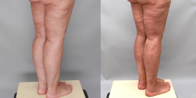 Ditesheim Cosmetic Surgery result — Charlotte, NC