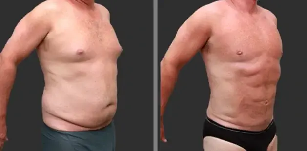 Liposuction result at Ditesheim Cosmetic Surgery in Charlotte, NC