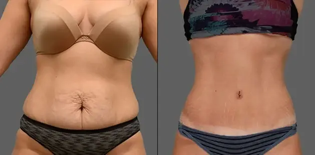 Ditesheim Cosmetic Surgery tummy tuck result — Charlotte, NC