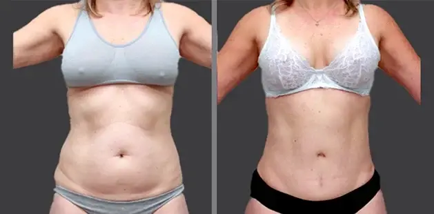 Mommy Makeover result at Ditesheim Cosmetic Surgery in Charlotte, NC