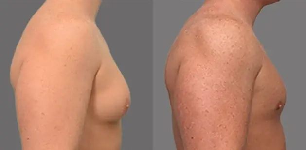 Ditesheim Cosmetic Surgery gynecomastia result — Charlotte, NC